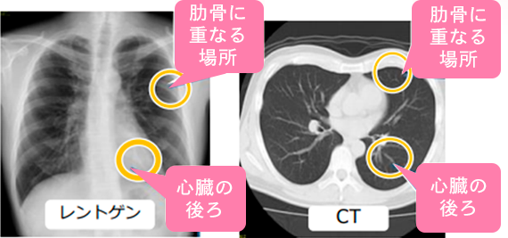 胸部レントゲン・胸部CTの違い